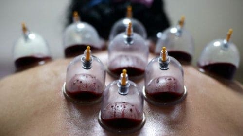 Puur Cupping - Hijama incisie